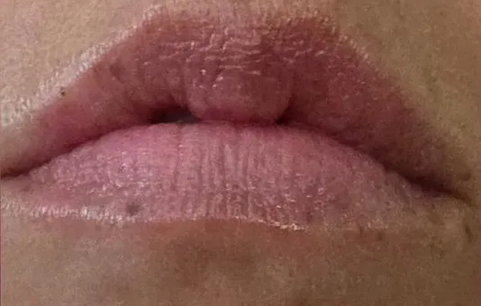 JT's lips after 2 weeks of using the balm