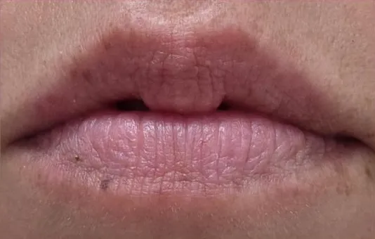 JT's lips before using the balm