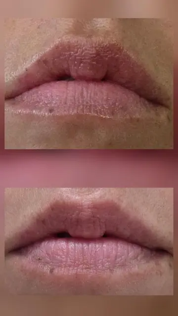 Customer lip photo from JT: top after 2 weeks, bottom before